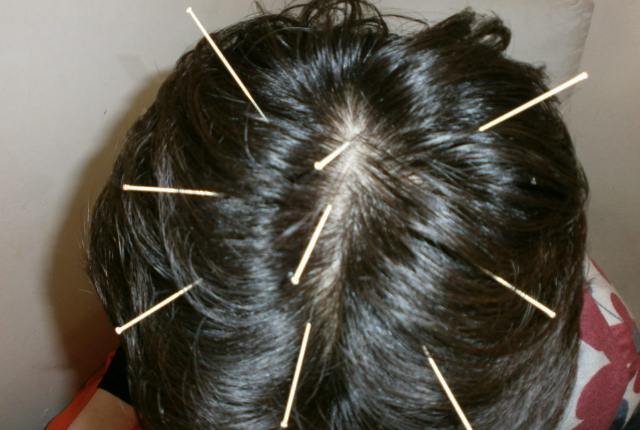 Acupressure Points Chart For Hair Growth