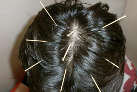 Seven Star Acupuncture Needle Can Heal Hair Loss Disposable
